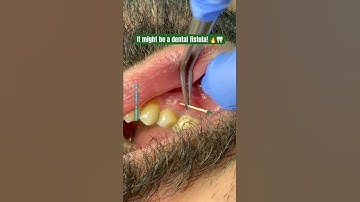 ⚠️ A pimple on your gums? It might be a dental fistula! 🦷🔥