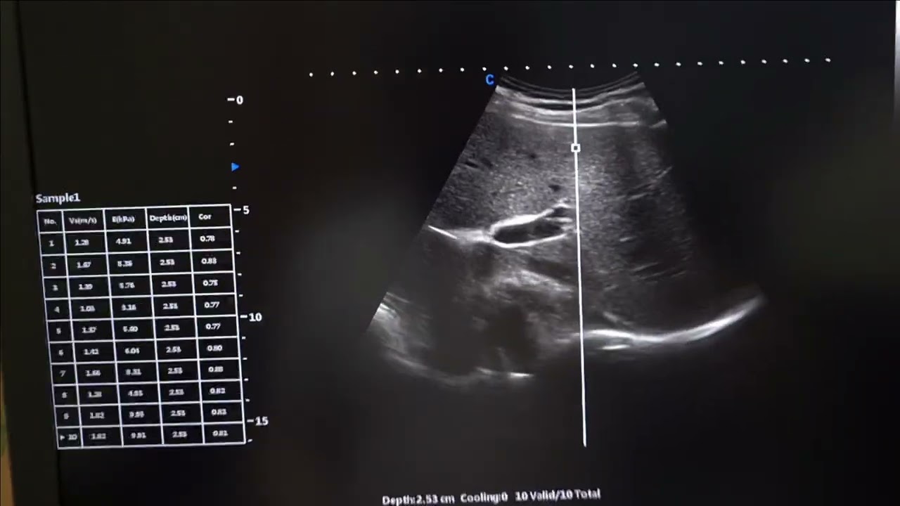 CHISON p-SWE эластометрия сдвиговой волной