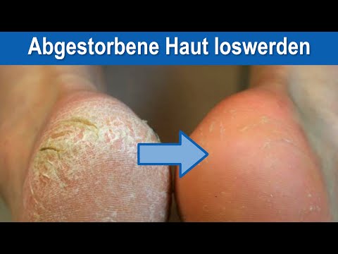 Video: 3 Möglichkeiten, abgestorbene Haut an den Füßen zu entfernen