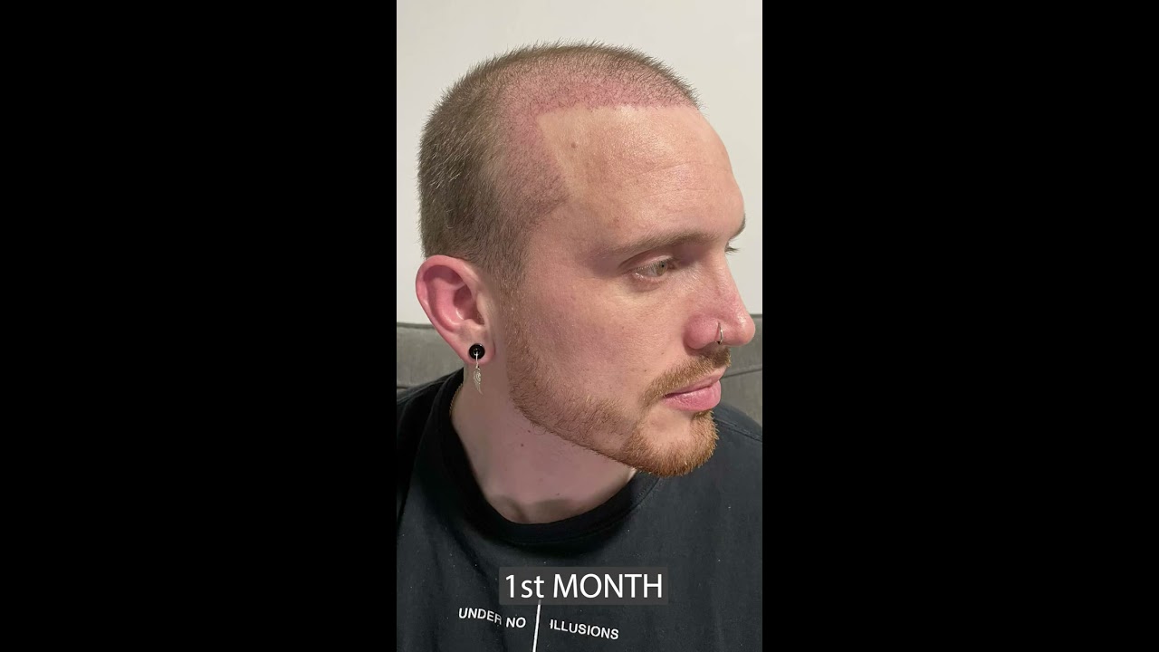 Hair Transplant 8 Months Result 