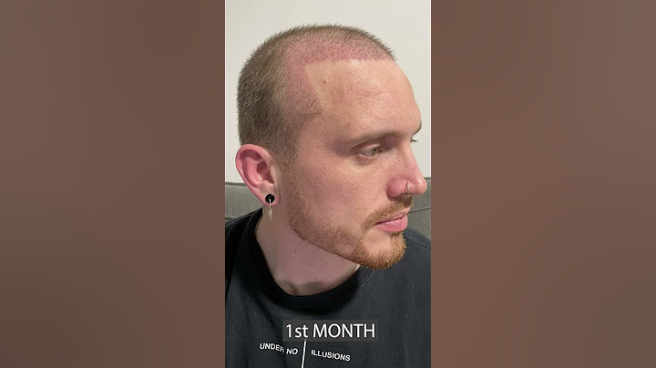 Hair Transplant - 8 Months Result!