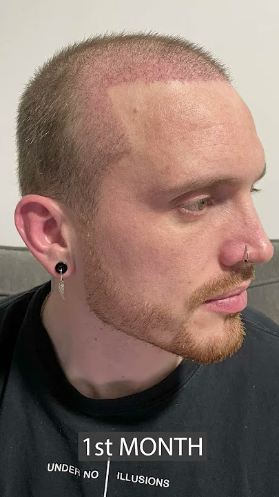 Hair Transplant - 8 Months Result!