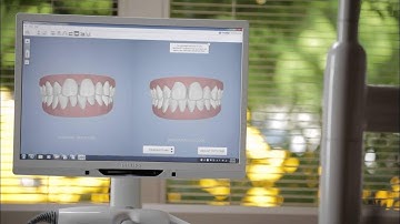 Invisalign® Outcome Simulator Demo Video