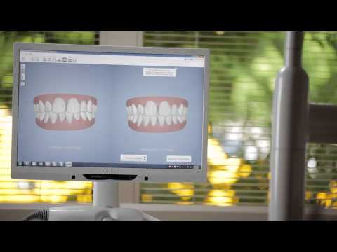 Invisalign® Outcome Simulator Demo Video