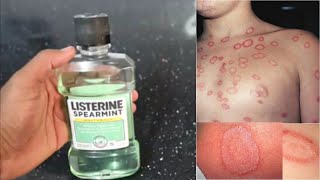 JUST ONE DAY || How To Cure  RINGWORM || IT IS EASY ||JUT DO IT || Mr. Maker