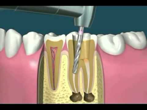 Видео: Киста на зъба (в корена) - причини и симптоми, отстраняване на кистата в корена на зъба (операция)