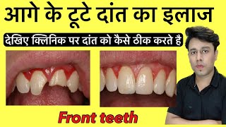 टूटे हुए दांत को कैसे ठीक करें ॥ broken teeth treatment || dr sumit gujare
