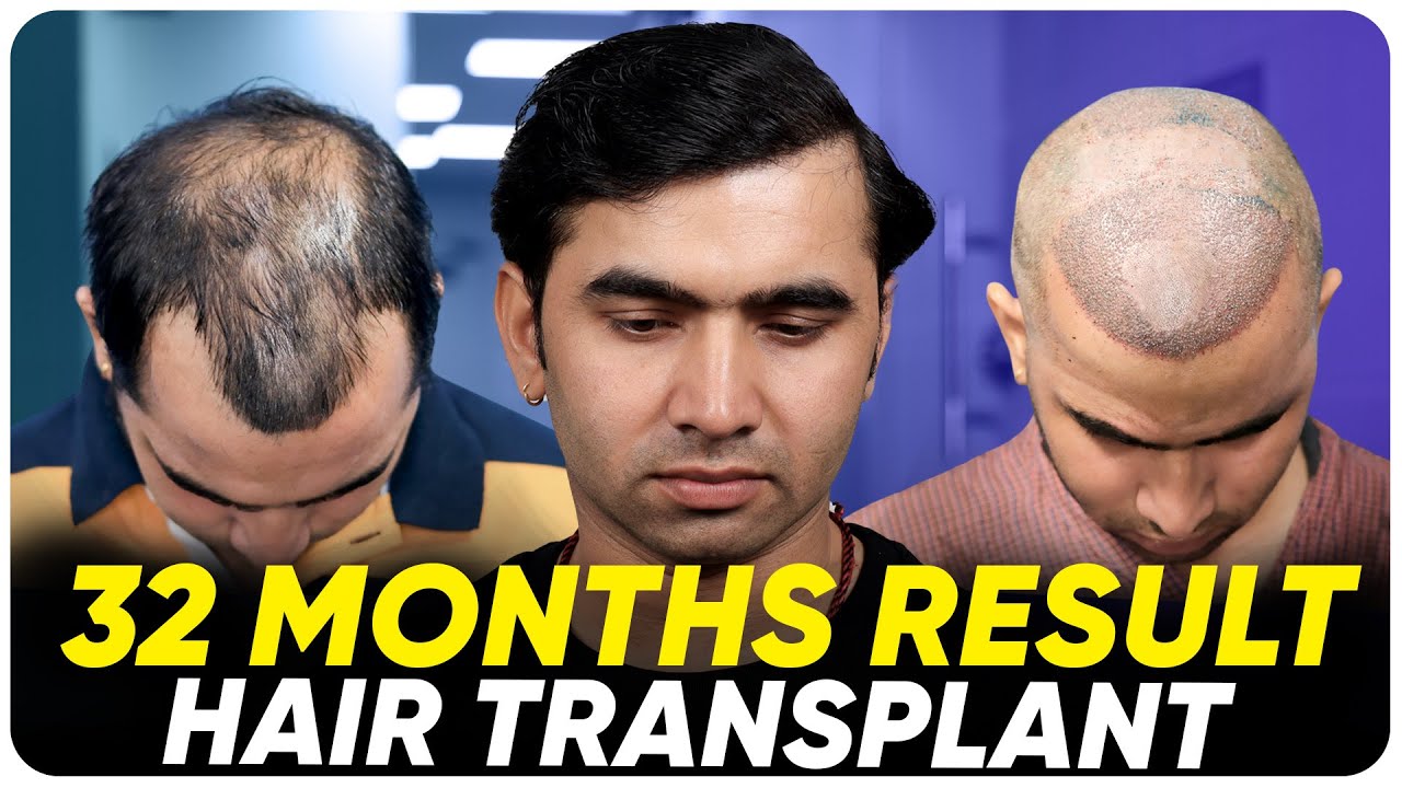 Hair Transplant in Kochi Best Results & Cost of Hair Transplant in