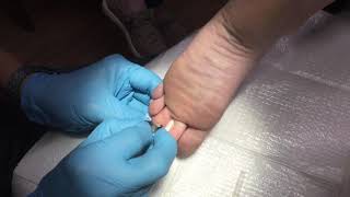 Wart removal with surgical blade and cautery