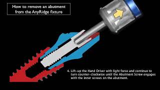 How to Remove Abutment from AnyRidge Implant Fixture  Abutment Removal Driver tutorial