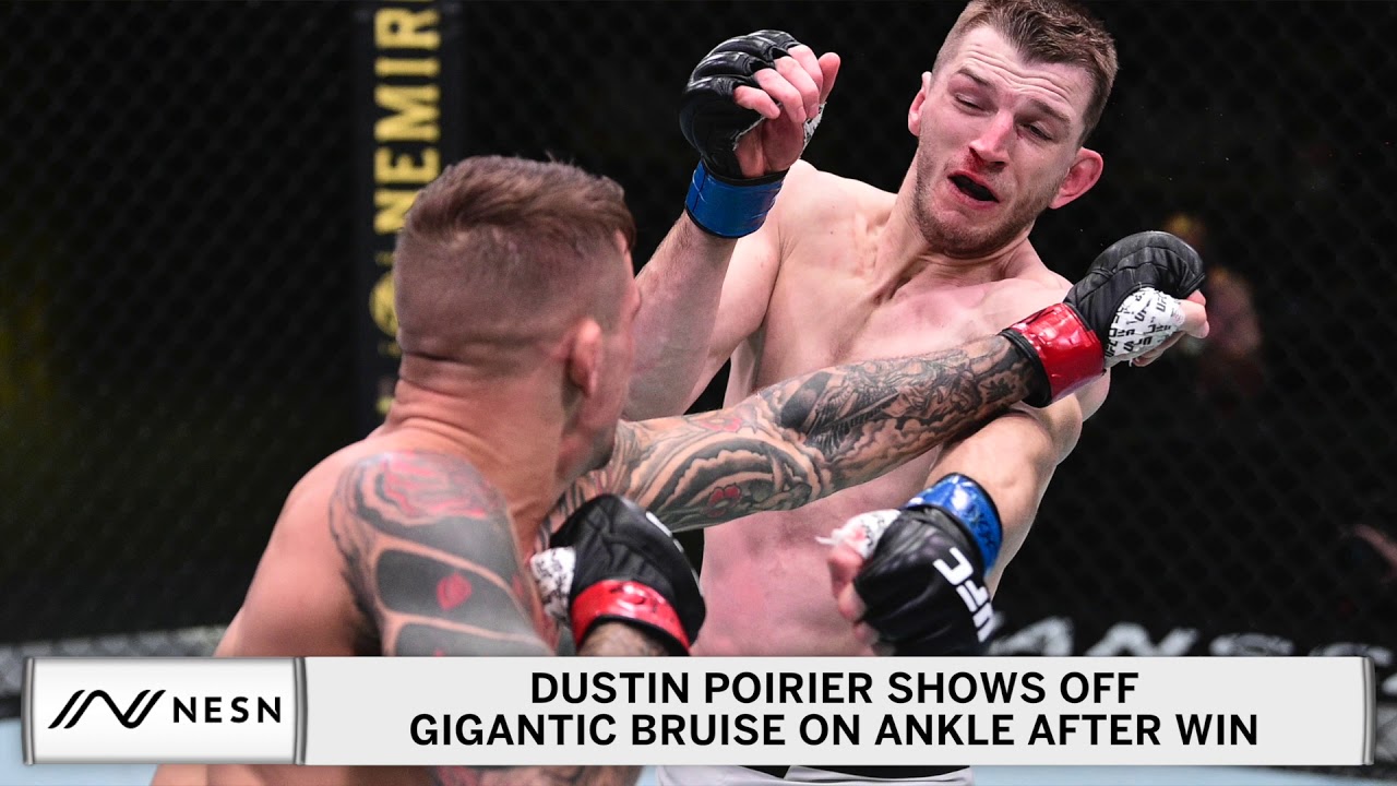 Dustin Poirier Shows Off Gruesome Bruise On Ankle After Dan Hooker Win