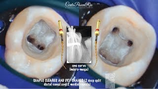 Assalamualaikum wr wb.. good morning!! ----- endodontic and
restorative treatment on mandibular right first molar with 6 (six)
canals. follow me http://in...