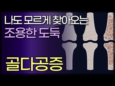 조용한 도둑 &rsquo;골다공증 &rsquo; / 뼈가 부러지고 나서야 알게되는 골다공증 / 골밀도가 감소하는 폐경 이후의 여성은 더 조심해야 한다 / 2151025 TV닥터인사이드