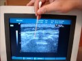 Ultrasound Guided Caudal Epidural Injection