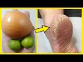 Remove Cracked Heels and Get Beautiful Feet | DIY Cracked Heels Home Remedy || DR HENG SOY