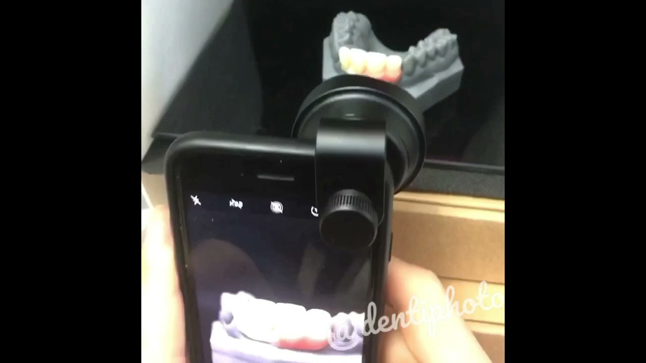 Phone macro lens for dental photography & dental technician. Dental mobile photography.