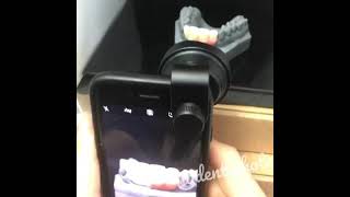 Phone macro lens for dental photography & dental technician. Dental mobile photography.