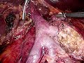 Laparoscopic Whipple - replaced hepatic artery from SMA (type 5)