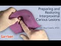 Preparing and Restoring Interproximal Carious Lesions | Mary Costello, EFDA