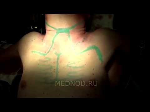 Рак щитовидной железы с врастанием в трахею и пищевод Рак щитовидной железы с врастанием в трахею и пищевод