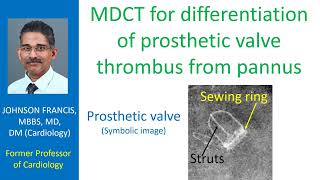 Mdct For Differentiation Of Prosthetic Valve Thrombus From Pannus