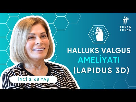 Başparmak Çıkıntısı Ameliyatı Olanların Yorumları: İnci Hanım (Lapidus 3D Halluks Valgus Ameliyatı)