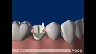 Universal adhesive Futurabond U-Part 12/12: Luting of root posts with a DC/CC luting composite