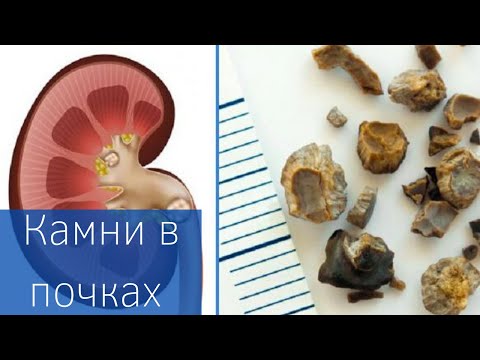 КАМНИ В ПОЧКАХ | Как лечить? | Профилактика