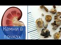 КАМНИ В ПОЧКАХ | Как лечить? | Профилактика