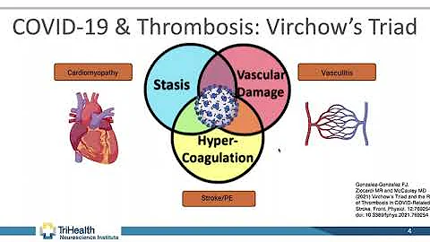 Impact of COVID-19 on Stroke & Aneurysm Risk | Chris Zammit, MD