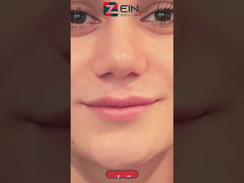 تغير رائع مع تطبيق فيلر الشفاه في مشفى زين قبل وبعد فيلر الشفاه