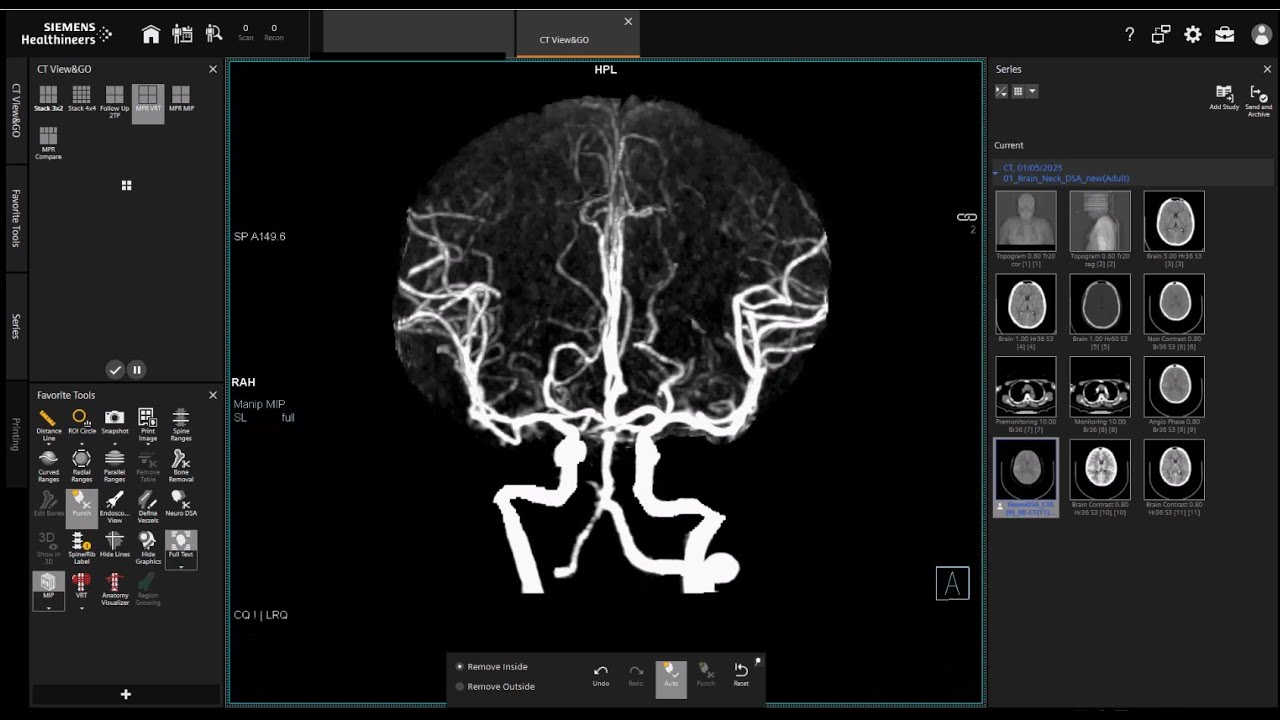 CT Cerebral angiogram