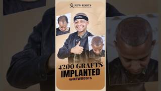 Hair Transplant in Bangladesh | Baldness Treatment | Cost & Best Results #hairtransplant #shorts