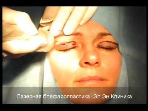 Лазерная блефаропластика век видео