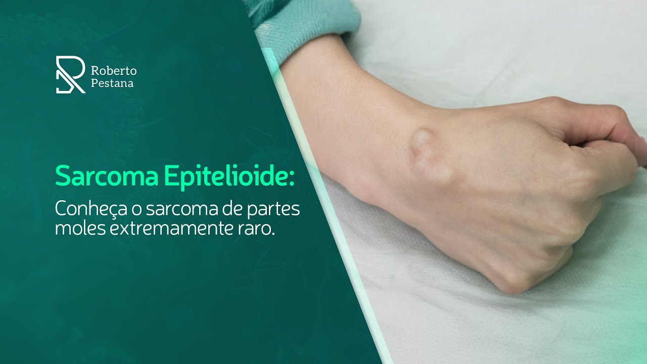 Conheça o sarcoma de partes moles extremamente raro!