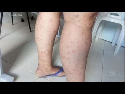 Vídeo: O que é a doença da sarna: informações sobre a doença da sarna da batata e a sarna das cucurbitáceas