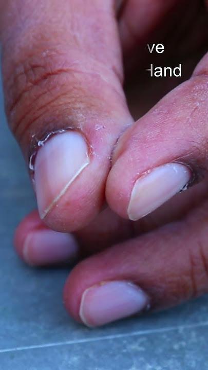 Remove Fevikwick from Fingers