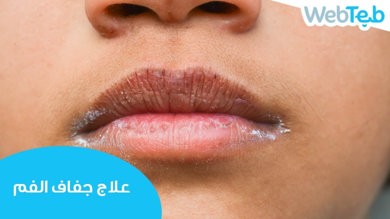 علاج جفاف الفم - ويب طب