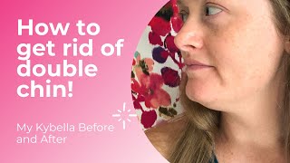 My Kybella Before and After - How to Get Rid of Double Chin!