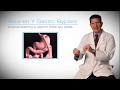 Roux-en-Y Gastric Bypass for Weight Loss