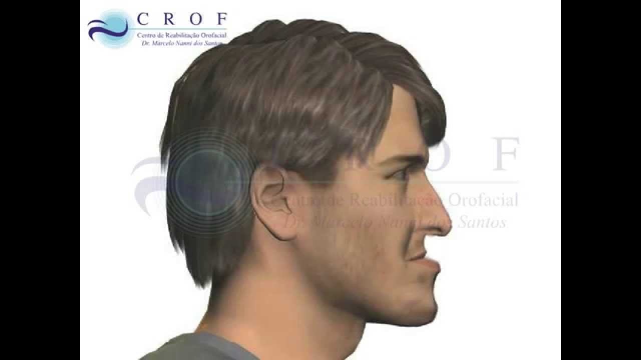 CIRURGIA ORTOGNÁTICA - RECUO DE MANDÍBULA E AVANÇO DE MAXILA - Dr. Marcelo Nanni
