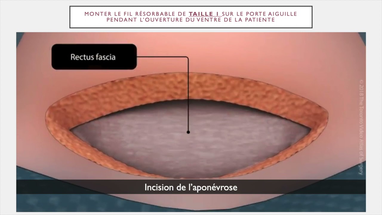 GUIDE DE L’EXTERNE POUR LES OPÉRATIONS DE CÉSARIENNE À LA MATERNITÉ DE ...