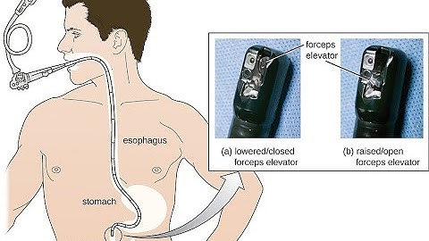 Esophagogastroduodenoscopy CPT code - simplify medical coding
