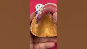 Locator Hybrid Bar for an Overdenture case