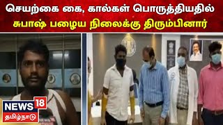 News18 Special | Kovai அரசு மருத்துவமனையில் Subash-க்கு Artificial Hand, Leg பொருத்தம் | Tamil News