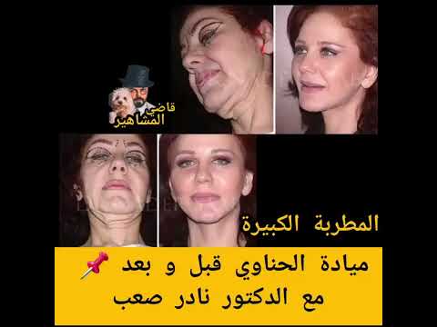 ميادة الحناوي تبدو بالعشرينات بعد عملية تجميل علا يد الدكتور نادر صعب