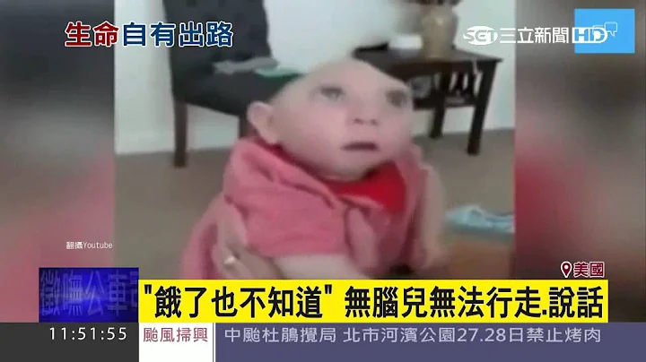 醫生斷言「活不久」　無腦兒奇蹟慶週歲│三立新聞台 - 天天要聞