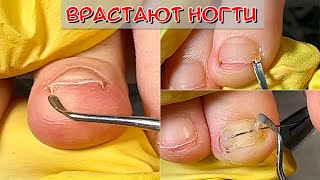 видео: Педикюр вросшие ногти / Врастают ногти на ногах картинка: Педикюр вросшие ногти / Врастают ногти на ногах