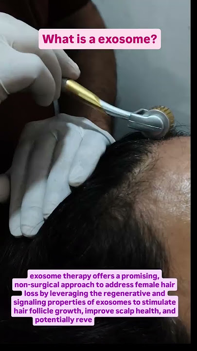 Exosome hair treatments