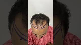 Most Trusted Hair Transplant Doctor in Hyderabad #DrVishal @9398866227